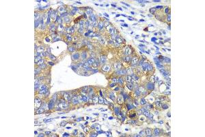 Immunohistochemistry of paraffin-embedded human gastric cancer using ARFGAP1 antibody at dilution of 1:100 (x40 lens). (ARFGAP1 antibody)
