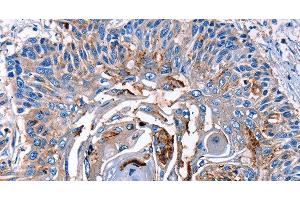 Immunohistochemistry of paraffin-embedded Human esophagus cancer tissue using LRP2 Polyclonal Antibody at dilution 1:40 (LRP2 antibody)