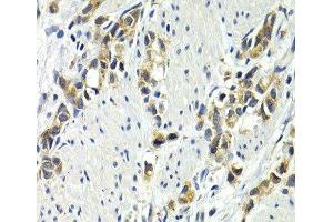 Immunohistochemistry of paraffin-embedded Human gastric cancer using WNT3A Polyclonal Antibody at dilution of 1:200 (40x lens). (WNT3A antibody)