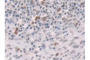DAB staining on IHC-P; Samples: Human Colorectal cancer Tissue (Glucocorticoid Receptor antibody  (AA 532-730))