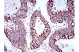 Immunohistochemical analysis of paraffin-embedded colon cancer tissues using SNAI2 mouse mAb with DAB staining.