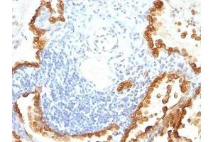 Formalin-fixed, paraffin-embedded human lung carcinoma stained with Cytokeratin 8 + 18 antibody (KRT8/803 + KRT18/835).