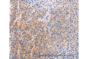 Immunohistochemistry of Human cervical cancer using ADHFE1 Polyclonal Antibody at dilution of 1:60 (ADHFE1 antibody)