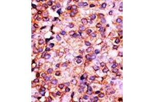 Formalin-fixed and paraffin-embedded human cancer tissue reacted with the primary antibody, which was peroxidase-conjugated to the secondary antibody, followed by AEC staining. (PANK3 antibody  (N-Term))