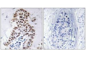 Immunohistochemistry analysis of paraffin-embedded human lung carcinoma tissue using DAPK3 (epitope around residue 265) antibody.