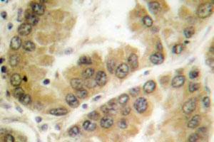 Immunohistochemical analysis of paraffin-embedded human lung cancer tissue using HDAC7 polyclonal antibody .