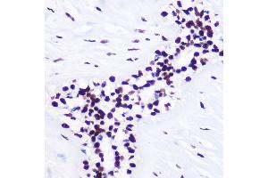 Immunohistochemistry of paraffin-embedded Human breast cancer using TriMethyl-Histone H3-K36 Rabbit pAb (ABIN3016038, ABIN3016039, ABIN3016040, ABIN1680217 and ABIN6219525) at dilution of 1:100 (40x lens). (Histone 3 antibody  (H3K36me3))