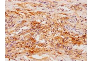 IHC image of ABIN7166626 diluted at 1:100 and staining in paraffin-embedded human lung cancer performed on a Leica BondTM system. (SFTPD antibody  (AA 50-64))