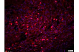 Formalin-fixed and paraffin-embedded human lung carcinoma labeled with Rabbit Anti-NCR1 Polyclonal Antibody, Unconjugatedused at 1:200 dilution for 40 minutes at 37°C. (NCR1 antibody  (AA 198-206))