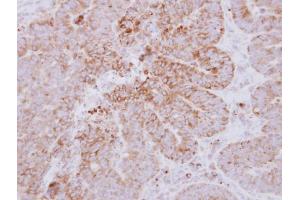 IHC-P Image Immunohistochemical analysis of paraffin-embedded human colon carcinoma, using GYG2, antibody at 1:500 dilution. (Glycogenin 2 antibody  (N-Term))