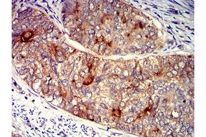 Immunohistochemical analysis of paraffin-embedded cervical cancer tissues using FOLR1 mouse mAb with DAB staining.