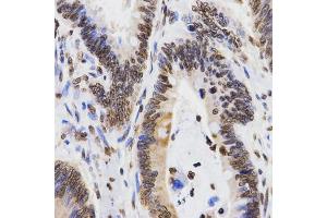 Immunohistochemistry of paraffin-embedded human rectal cancer using DiMethyl-Histone H3-K9 antibody (ABIN1872998) at dilution of 1:200 (40x lens). (Histone 3 antibody  (H3K9me2))
