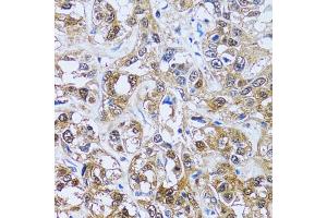 Immunohistochemistry of paraffin-embedded human liver cancer using IMPA1 antibody (ABIN2563424) at dilution of 1:100 (40x lens). (IMPA1 antibody)