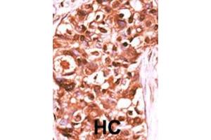 Formalin-fixed and paraffin-embedded human cancer tissue reacted with the primary antibody, which was peroxidase-conjugated to the secondary antibody, followed by DAB staining. (STAT5A antibody  (pTyr694))