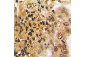 Immunohistochemical analysis of PSMD7 staining in human lung cancer formalin fixed paraffin embedded tissue section. (PSMD7 antibody)