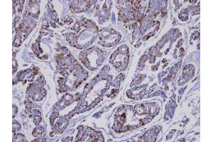 IHC-P Image Immunohistochemical analysis of paraffin-embedded human Thyroid gland tumor, using INPP1 , antibody at 1:100 dilution. (INPP1 antibody)