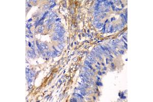 Immunohistochemistry of paraffin-embedded human colon carcinoma using HIP1 antibody at dilution of 1:100 (x40 lens). (HIP1 antibody)