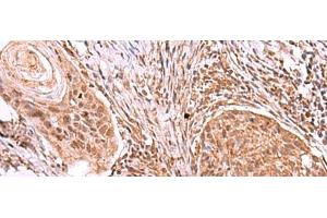 Immunohistochemistry of paraffin-embedded Human esophagus cancer tissue using IRX4 Polyclonal Antibody at dilution of 1:40(x200) (IRX4 antibody)