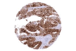 Colon Colorectal adenocarcinoma with moderate to strong membranous PD L1 staining in the vast majority of its tumor cells (Recombinant PD-L1 antibody)