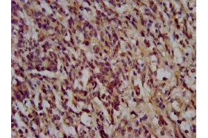 IHC image of ABIN7169549 diluted at 1:200 and staining in paraffin-embedded human gastric cancer performed on a Leica BondTM system. (NANS antibody  (AA 132-259))