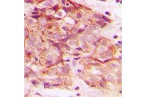 Immunohistochemical analysis of ERGIC3 staining in human breast cancer formalin fixed paraffin embedded tissue section. (ERGIC3 antibody  (C-Term))