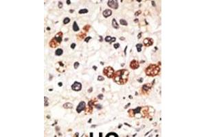 Formalin-fixed and paraffin-embedded human cancer tissue reacted with the primary antibody, which was peroxidase-conjugated to the secondary antibody, followed by DAB staining. (Connexin 31 antibody  (C-Term))