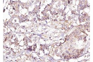 ABIN6267457 at 1/100 staining human Breast carcinoma tissue sections by IHC-P. (SHC1 antibody  (pTyr427))