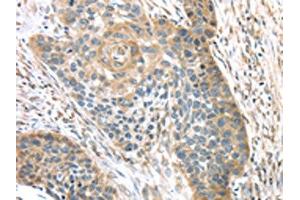 The image on the left is immunohistochemistry of paraffin-embedded Human esophagus cancer tissue using ABIN7131395(TMPRSS11A Antibody) at dilution 1/30, on the right is treated with fusion protein. (TMPRSS11A antibody)