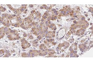 ABIN6272490 at 1/100 staining Human liver cancer tissue by IHC-P. (CACNA1G antibody  (N-Term))