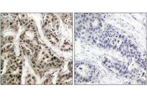 Immunohistochemistry analysis of paraffin-embedded human breast carcinoma, using NF-kappaB p105/p50 (Phospho-Ser337) Antibody. (NFKB1 antibody  (pSer337))