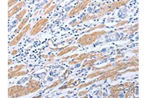The image on the left is immunohistochemistry of paraffin-embedded Human gastric cancer tissue using ABIN7190790(GFRA4 Antibody) at dilution 1/40, on the right is treated with synthetic peptide. (GFRA4 antibody)