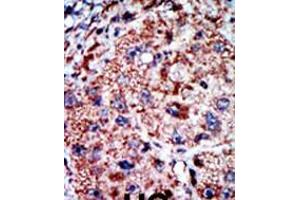 Formalin-fixed and paraffin-embedded human cancer tissue reacted with the primary antibody, which was peroxidase-conjugated to the secondary antibody, followed by AEC staining. (PFKL antibody  (C-Term))