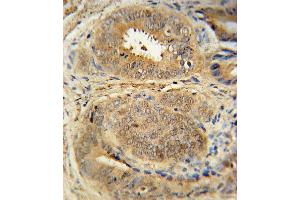 Mdm2 Antibody immunohistochemistry analysis in formalin fixed and paraffin embedded human prostate carcinoma followed by peroxidase conjugation of the secondary antibody and DAB staining. (MDM2 antibody  (C-Term))