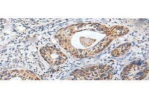 Immunohistochemistry of paraffin-embedded Human cervical cancer tissue using ZPBP Polyclonal Antibody at dilution of 1:30(x200)