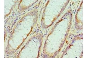 Immunohistochemistry of paraffin-embedded human colon cancer using ABIN7152105 at dilution of 1:100
