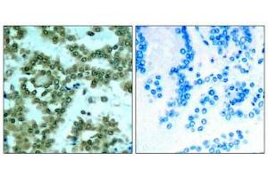Immunohistochemical analysis of paraffin-embedded human lung carcinoma tissue using PKCth(Phospho-Ser676) Antibody(left) or the same antibody preincubated with blocking peptide(right). (PKC theta antibody  (pSer676))