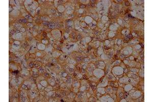 IHC image of ABIN7127636 diluted at 1:100 and staining in paraffin-embedded human liver cancer performed on a Leica BondTM system. (Recombinant N-Cadherin antibody)