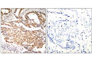 Immunohistochemical analysis of paraffin-embedded human breast carcinoma tissue using MEF2A (Phospho-Ser408) antibody (E011309). (MEF2A antibody  (pSer408))