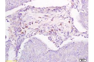 Formalin-fixed and paraffin embedded ovarian cancer xenograft labeled with Anti-DBC2 receptor Polyclonal Antibody, Unconjugated (ABIN706241) followed by conjugation to the secondary antibody and DAB staining (RHOBTB2 antibody  (AA 631-727))