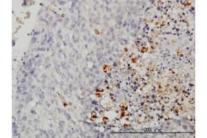 Immunoperoxidase of monoclonal antibody to CASP1 on formalin-fixed paraffin-embedded human hepatocellular carcinoma. (Caspase 1 antibody  (AA 1-100))