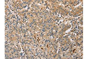 The image on the left is immunohistochemistry of paraffin-embedded Human gastric cancer tissue using ABIN7128517(ARL8A Antibody) at dilution 1/20, on the right is treated with fusion protein. (ARL8A antibody)