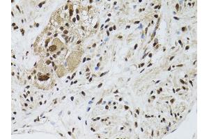 Immunohistochemistry of paraffin-embedded human colon carcinoma using STK11 antibody (ABIN5971149) at dilution of 1/100 (40x lens). (LKB1 antibody)