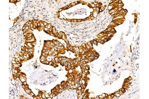 ABIN6265728 and ABIN6266730 at 1/100 staining Human lung cancer by IHC-P. (TRIM16 antibody  (N-Term))