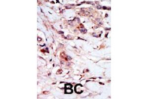 Formalin-fixed and paraffin-embedded human cancer tissue reacted with NPR1 polyclonal antibody  , which was peroxidase-conjugated to the secondary antibody, followed by AEC staining. (NPR1 antibody  (N-Term))