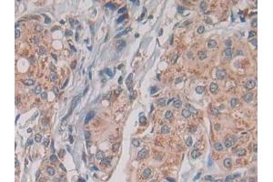 Detection of TLR1 in Human Breast cancer Tissue using Monoclonal Antibody to Toll Like Receptor 1 (TLR1) (TLR1 antibody  (AA 114-339))