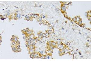 Immunohistochemistry of paraffin-embedded Human lung cancer using ART1 Polyclonal Antibody at dilution of 1:100 (40x lens). (ART1 antibody)
