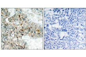Immunohistochemical analysis of paraffin-embedded human breast carcinoma tissue using Integrin b3(Phospho-Tyr773) Antibody(left) or the same antibody preincubated with blocking peptide(right).