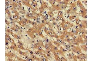 Immunohistochemistry of paraffin-embedded human liver cancer using ABIN7163052 at dilution of 1:100 (PHF21A antibody  (AA 312-487))