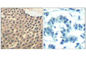Immunohistochemical analysis of paraffin-embedded human lung carcinoma tissue using HDAC4/HDAC5/HDAC9(Ab-246/259/220) Antibody(left) or the same antibody preincubated with blocking peptide(right).
