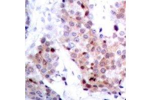 Immunohistochemical analysis of p53 staining in human breast cancer formalin fixed paraffin embedded tissue section. (p53 antibody)